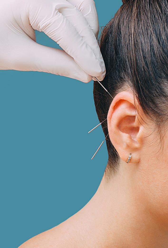 AURICULAR ACUPUNCTURE AURICULAR ACUPUNCTURE